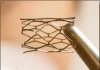 PMR Research conducted research on the stent market among interventional cardiologists